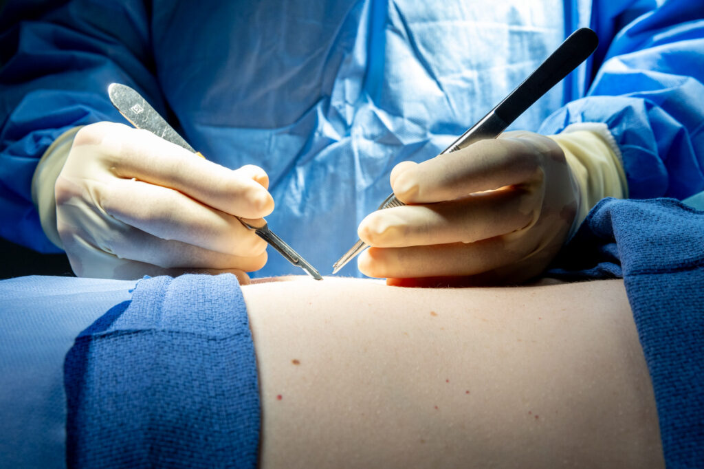 A close-up of Dr. Salas using surgical equipment to perform a procedure on a patient's postpartum body in Pembroke Pines.