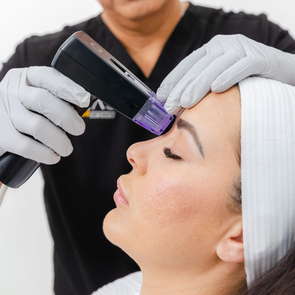 A Salas provider, wearing gloves, holds the Morpheus8 hand-held applicator agains the middle of a young woman's brow. Many patients choose this to help highlight their eyes after having Latisse in Pembroke Pines.