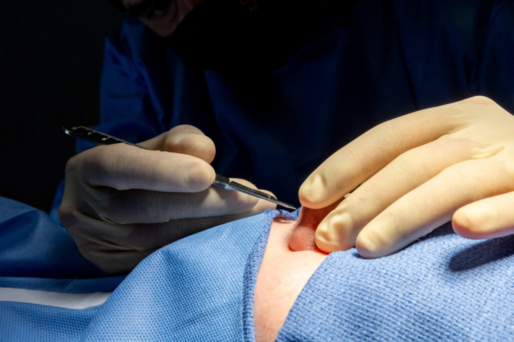 A close-up of a rhinoplasty procedure, reflecting facial balancing in Pembroke Pines.