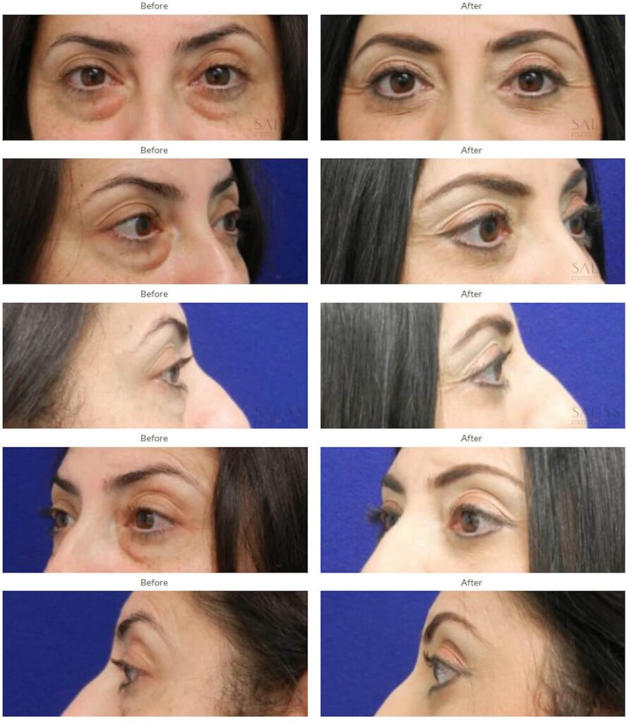 A series of before and after blepharoplasty pictures of a woman's eyes. These improvements were part of her facial rejuvenation in Pembroke Pines.