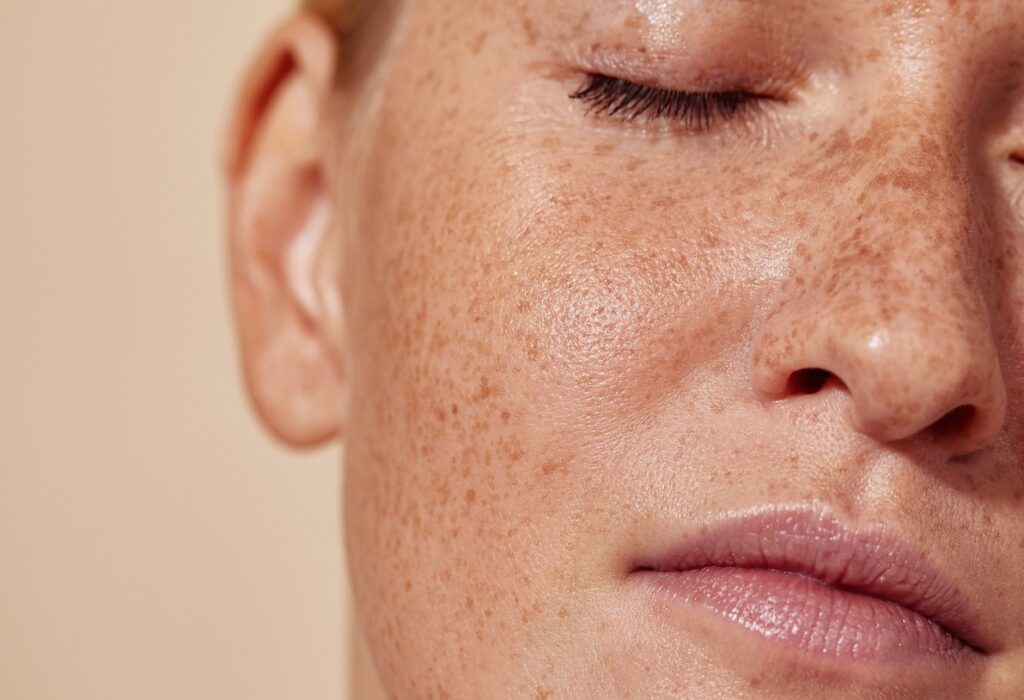 A young woman with freckles. She thinks she has Dark Spots on Face in Pembroke Pines, so she came to Salas to inquire.